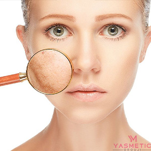 راهنمای جامع از بین بردن لکه های پوستی